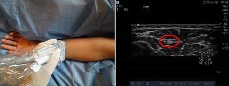 Median_Nerve.jpg